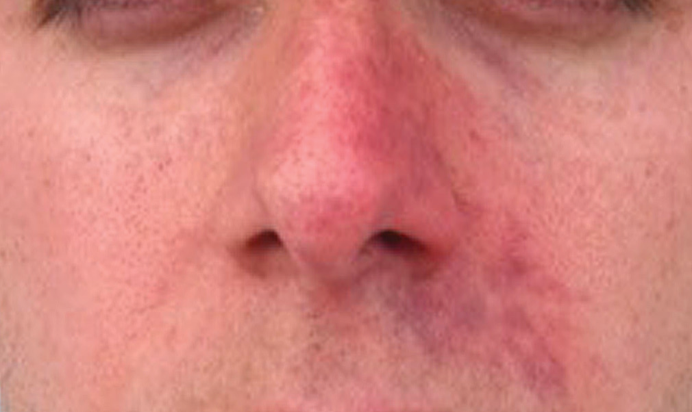 Soft tissue ischaemia