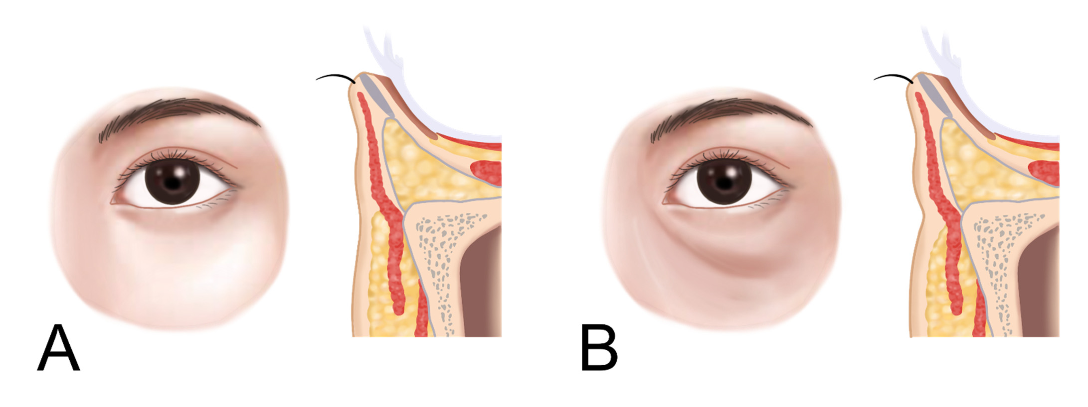 Infraorbital hollowness